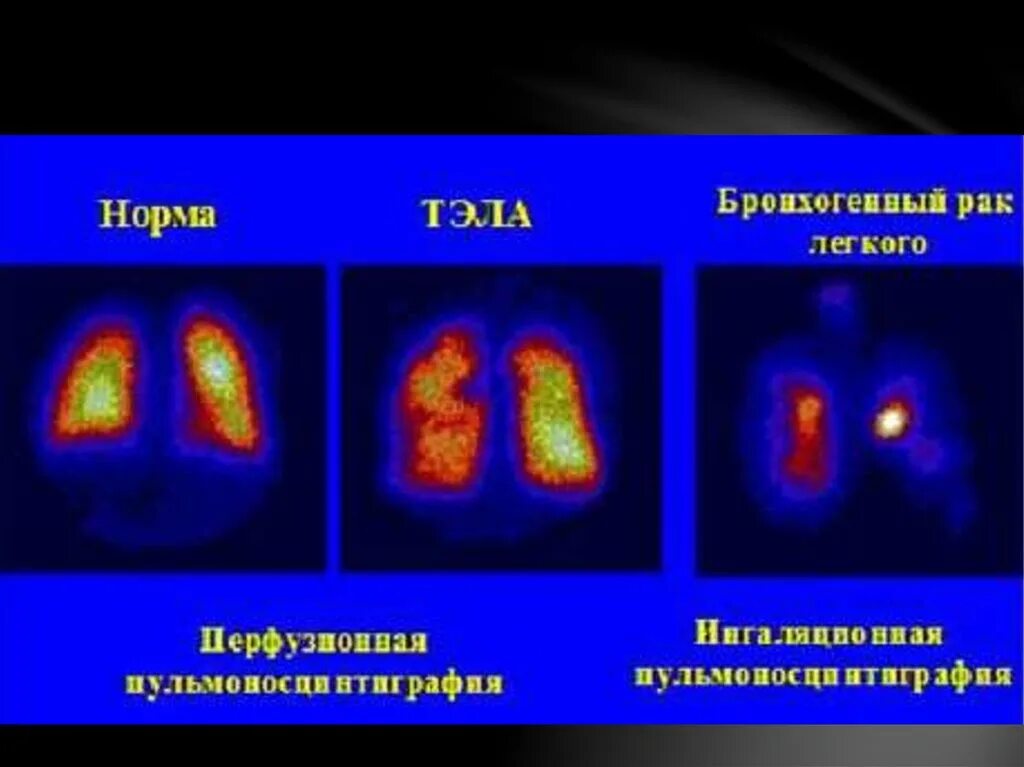 Исследование изотопами. Радиоизотопные (радионуклидные) исследования. Перфузионная сцинтиграфия легких норма. Радионуклидная сцинтиграфия печени. Радиоизотопный метод сцинтиграфия.