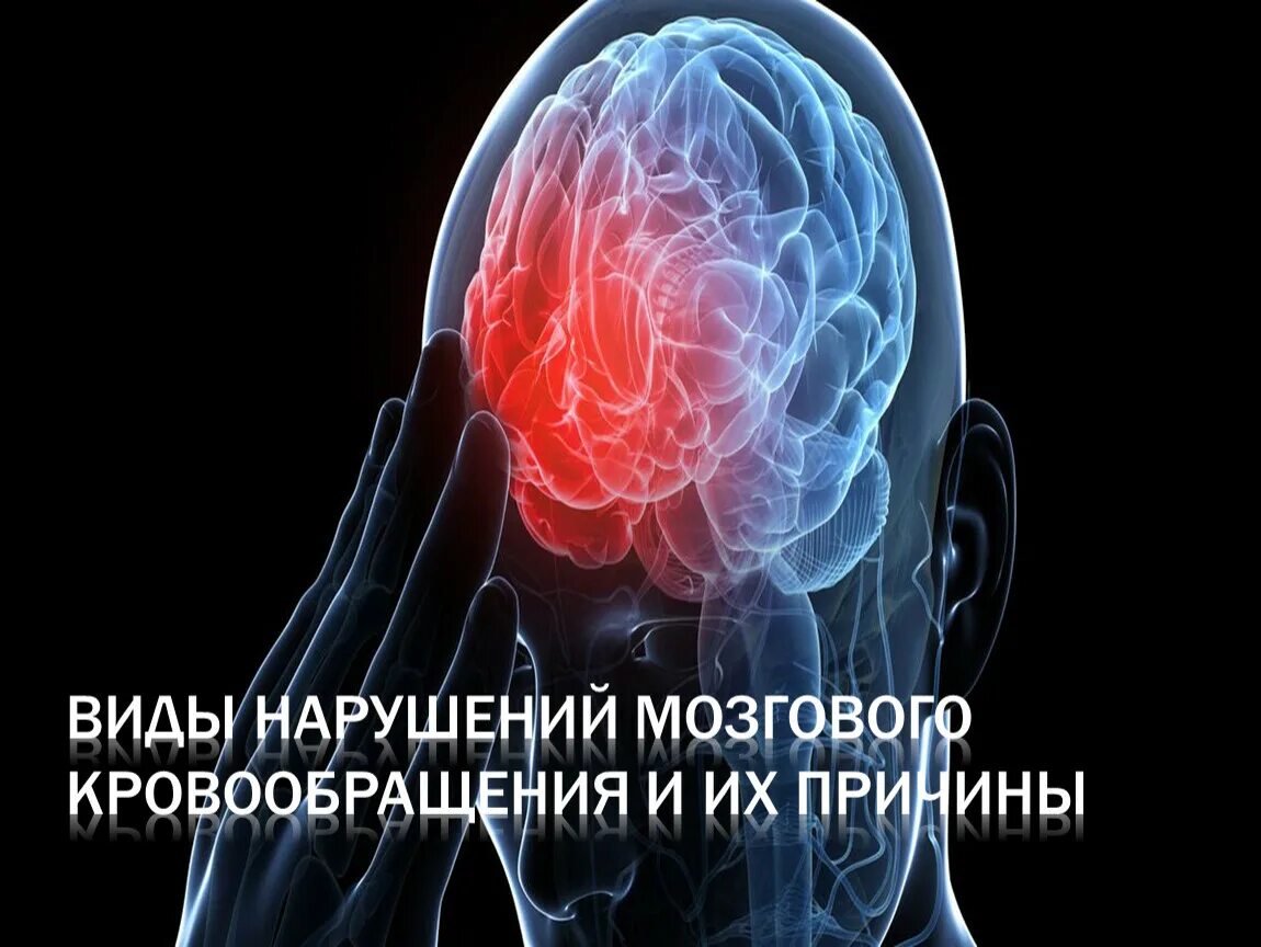 Мозговое кровообращение неврология. Нарушение мозгового кровообращения. Нарушения мозгового кровообращения неврология. Нарушение мозгового кровообращения картинки. Симптомокомплекс нарушения мозгового кровообращения.