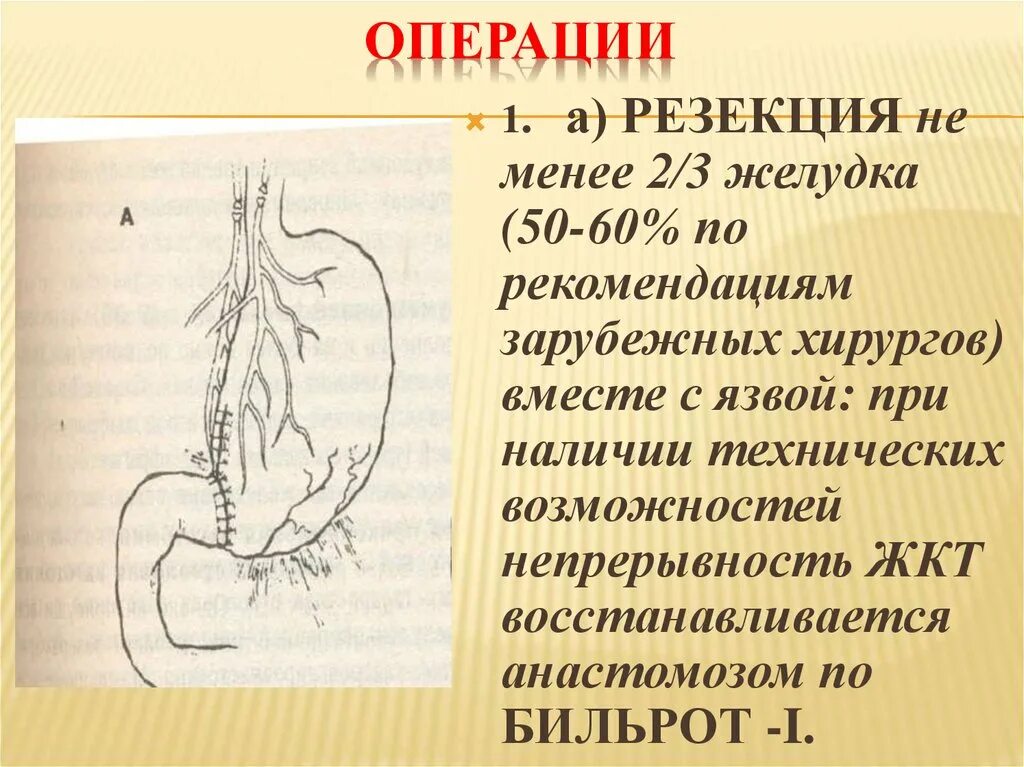 Операция резекция