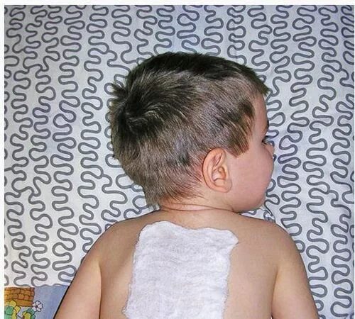 Постановка горчичников на спину. Горчичники при кашле при бронхите. Горчичники на спину при кашле. Горчичники на спину детям. Горчичник компресс.