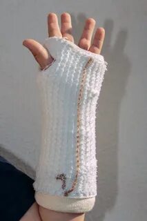 Рука ребенка в гипсе
