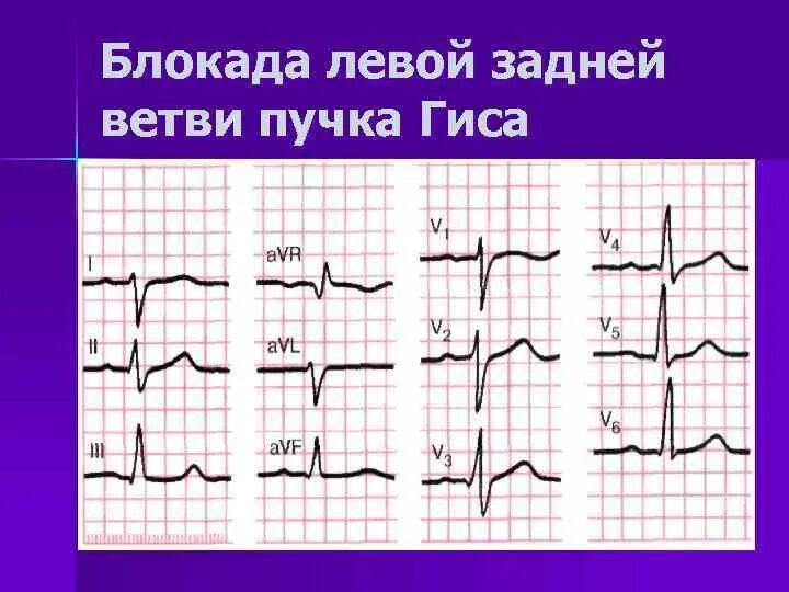 Неполная блокада передней. Блокада задней ветви пучка Гиса на ЭКГ. Блокады ветвей пучка Гиса на ЭКГ. Блокада передней левой ножки пучка Гиса. Блокада левой передней ветви на ЭКГ.