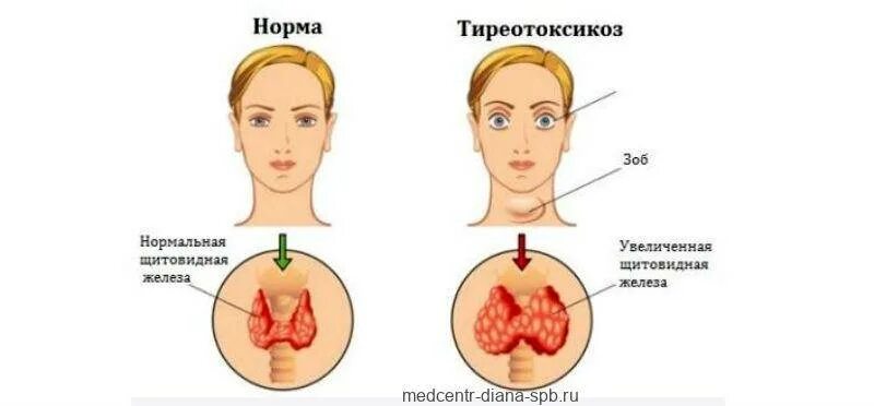 Гипертиреоз норма. Манифестный гипотиреоз ттг и т4. Нарушение щитовидной железы. Показатели гормонов щитовидной железы при гипертиреозе. Гипертиреоз механизм развития симптомов.