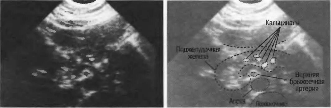 Кальцинат в печени на узи. Кальцинаты поджелудочной железы УЗИ. Кальцификация поджелудочной железы. Кальцификаты УЗИ поджелудочная.