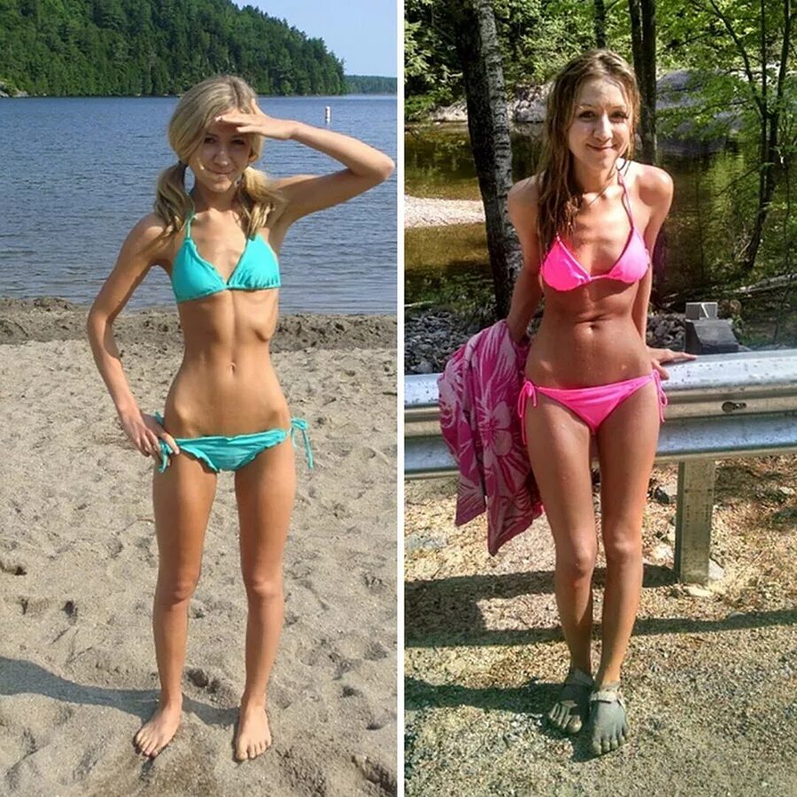Вес при анорексии