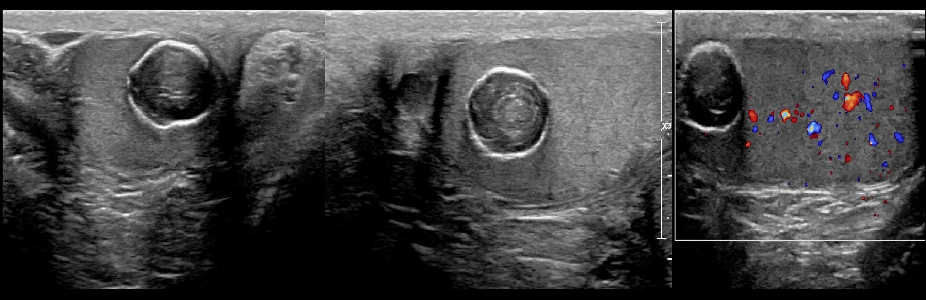 Воспаление семенного канатика у мужчин. Гематоцеле яичка УЗИ картины. Опухоли придатка яичка на УЗИ. Киста придатков яичка УЗИ.