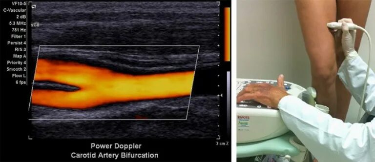 Дуплексное сканирование вен нижних конечностей что это. Ультразвуковая допплерография артерий нижних конечностей. Ультразвуковое дуплексное ангиосканирование. Допплеровское сканирование вен нижних конечностей. Ультразвуковое компрессионное дуплексное ангиосканирование.