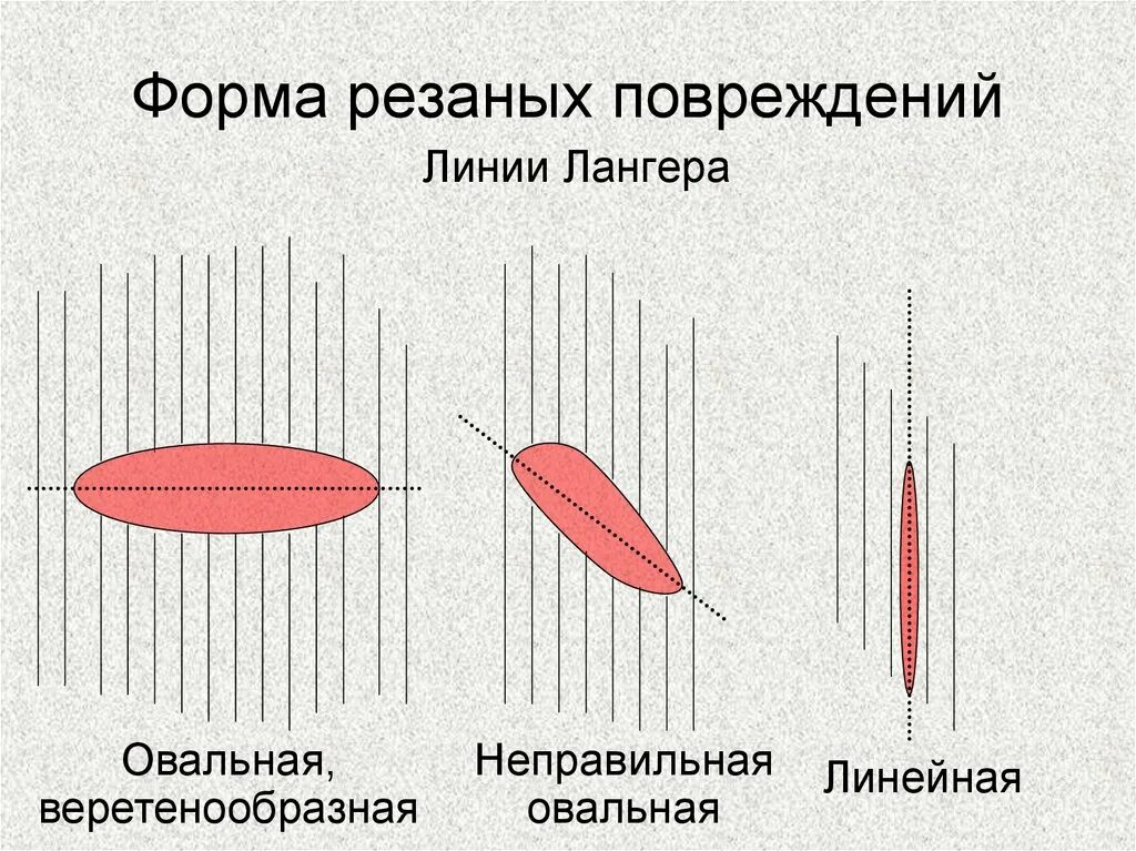 Веретенообразная форма повреждения. Веретенообразная форма раны. Формы колото оезанных РАН. Резаная рана веретенообразной формы.