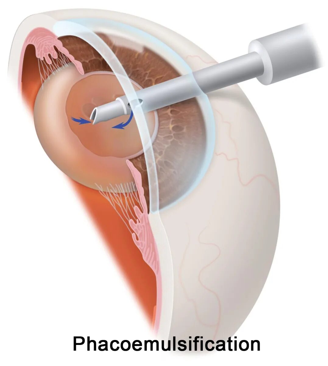Катаракта факоэмульсификация. Факоэмульсификация катаракты с имплантацией ИОЛ. Катаракта имплантация ИОЛ. Лазерная экстракция катаракты.