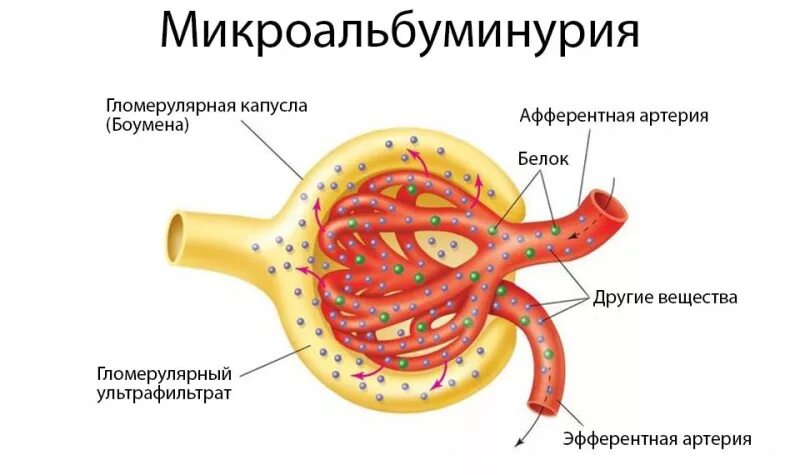 Микроальбумин в моче лечение. Микроальбуминурия. Альбумин мочи микроальбуминурия. Микроальбумин в моче что это такое. Микроальбуминурия анализ.