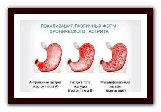 Воздействие кофе на желудок. Кофе и гастрит. Кофе при гастрите. Действие кофе на ЖКТ. Кофе при язве желудка