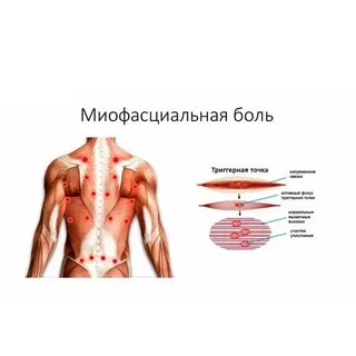 Мышечные узлы