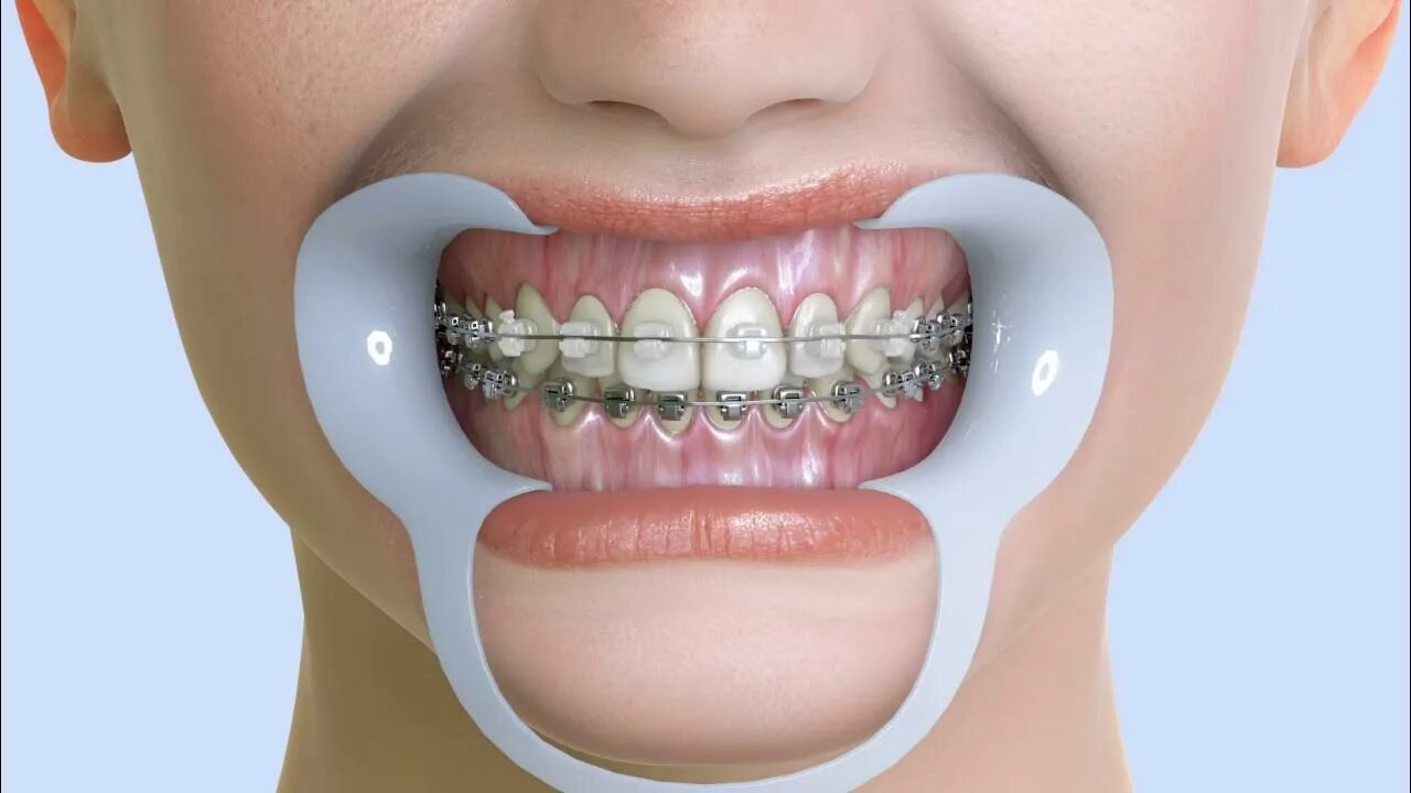 Стоматология брекеты. Держатель для рта в стоматологии. Ретрактор стоматологический ортодонтический.