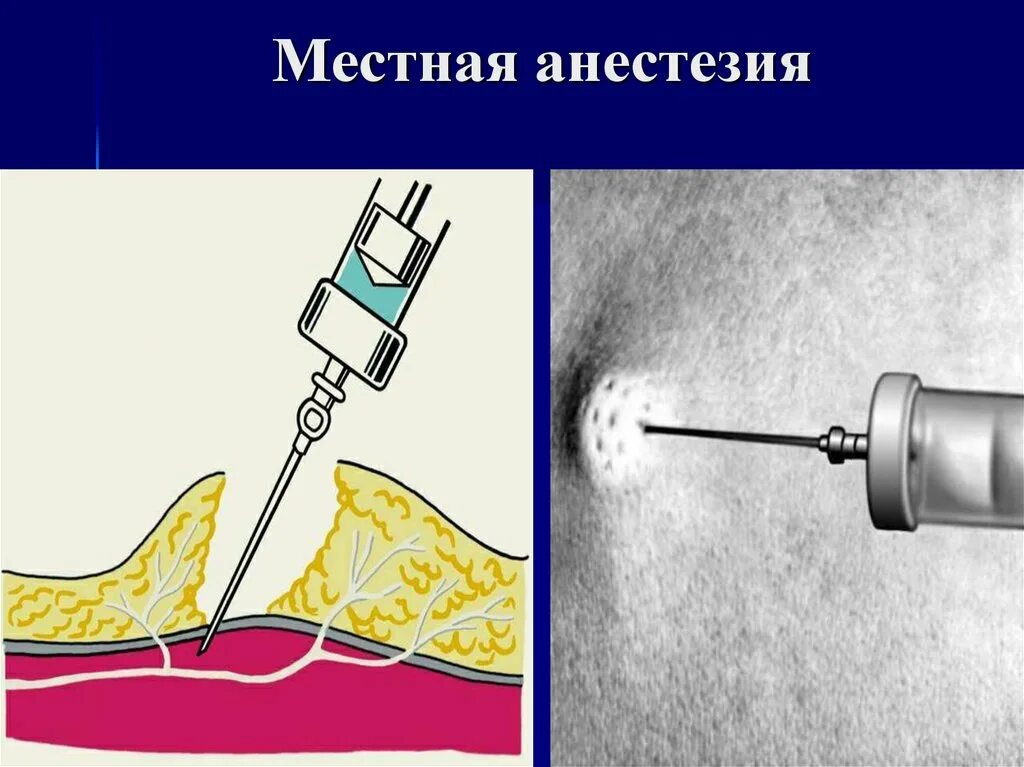 Что такое местный наркоз