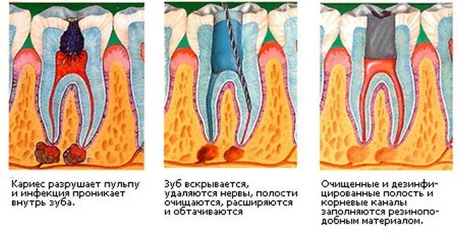 Воспаление канала зуба. Периодонтит зубов зубов. Периодонтит 1 канальный.