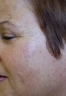 Отсутствие кожных желез