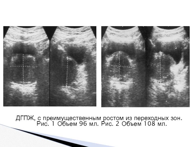 Дгпж узи. Аденома предстательной железы на УЗИ. УЗИ предстательной железы трансабдоминально. Зоны предстательной железы на УЗИ.