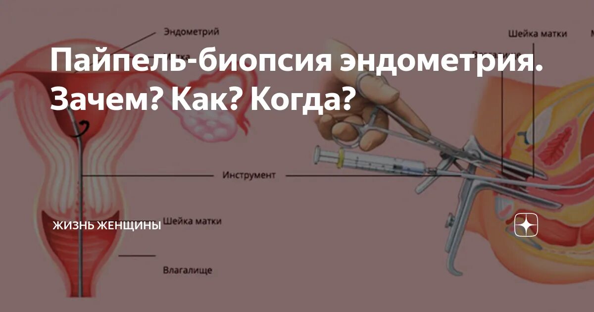 Биопсия эндометрия как делают. Аспирационная пайпель биопсия эндометрия. Афиционая биопсия эндометрия. Пайпель-биопсия (аспирационная биопсия эндометрия).