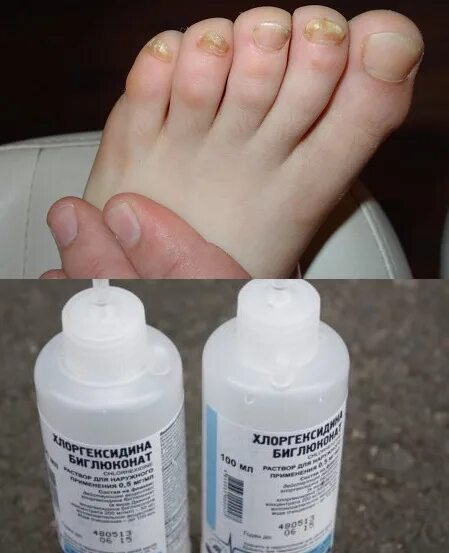 Обрабатывать брови хлоргексидином. Средство для грибка ногтей на ногах.