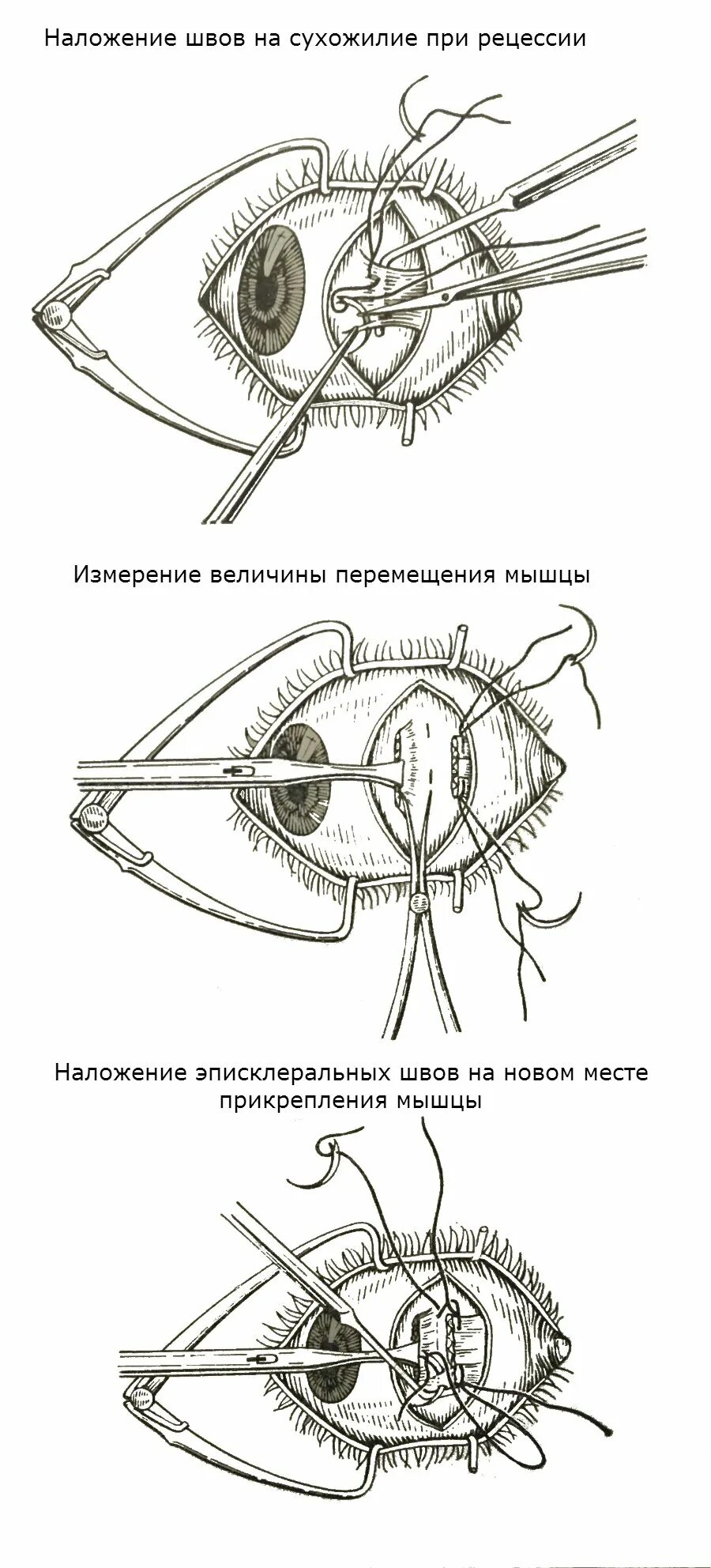 Рецессия глазодвигательной мышцы. Глазодвигательные мышцы глаза. Операция по косоглазию. Операция по коррекции косоглазия.
