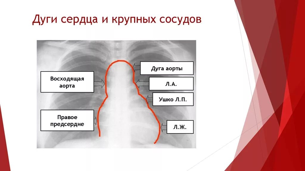 Норма форма сердца. Контуры сердца на рентгенограмме схема. Дуги сердца на рентгенограмме. Левый контур сердца на рентгенограмме. Дуги сердца на рентгене.