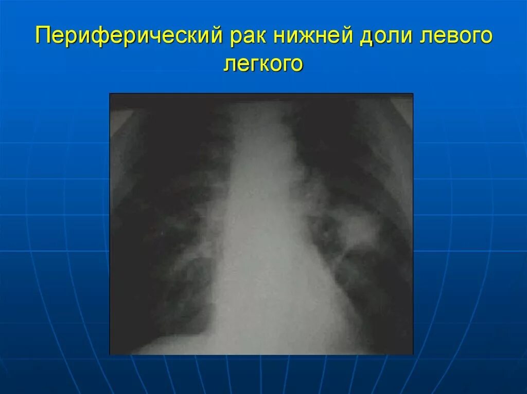 Периферическое образование левого легкого. Опухоль нижней доли левого легкого. Периферическая опухоль легкого. Периферический са правого легкого. Периферическая опухоль верхней доли правого легкого.