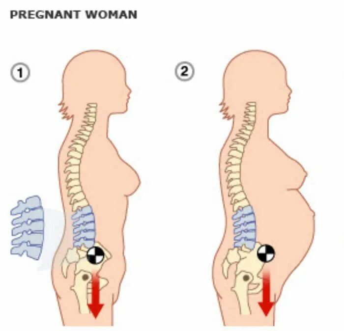 Боли в спине после родов. Беременность и позвоночник. Лордоз. Осанка беременных. Позвоночник беременной женщины.