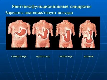 Атония желудка