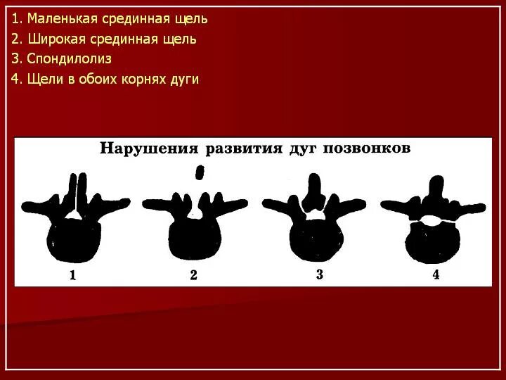 Пороки развития позвоночника. Аномалия развития остистого отростка. Варианты и аномалии развития позвонков.