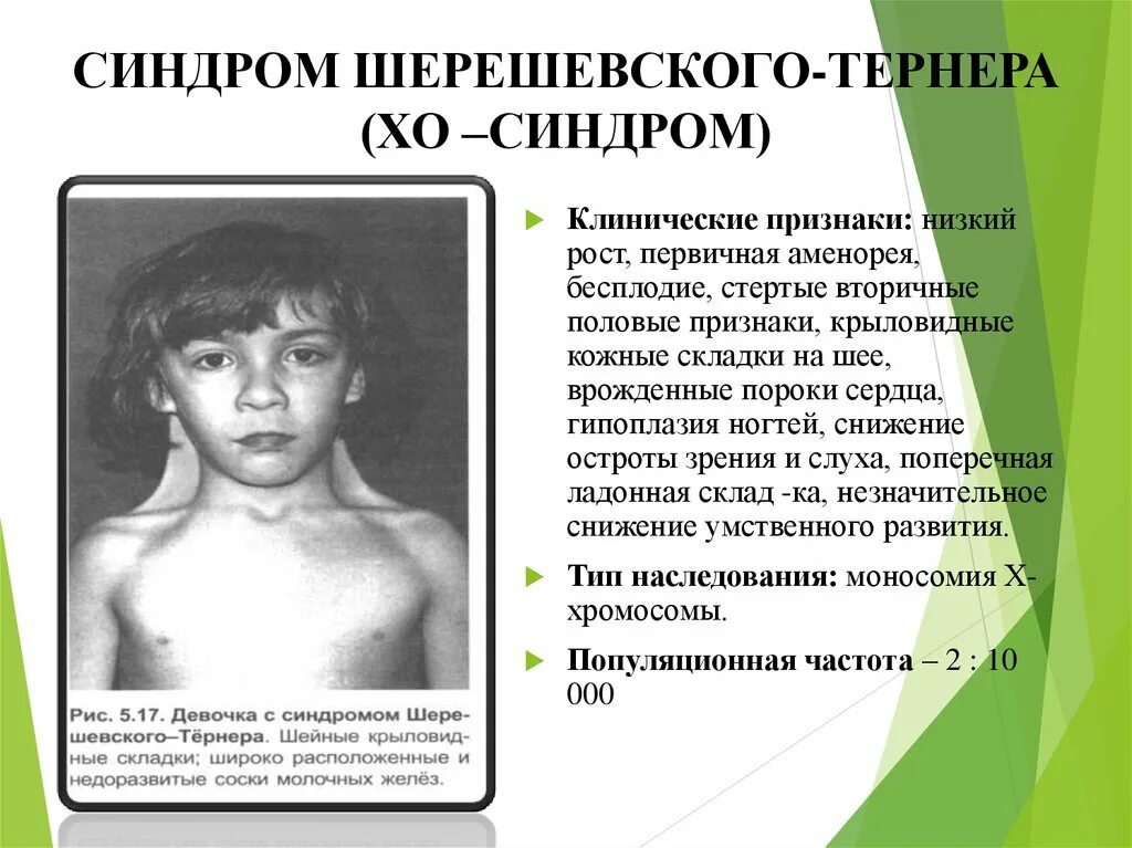 Хелиф синдром свайера. Шерешевский тернер синдром симптомы. наследственные заболевания шерешевского тернера. синдром шерешевского тернера возникает вследствие нарушений. синдром шерешевского тернера клинические симптомы.