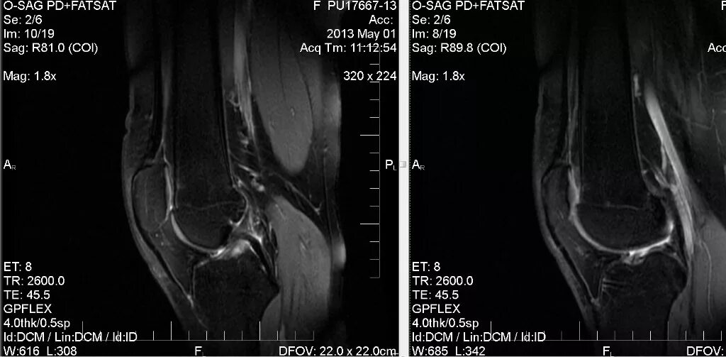 Мрт коленного сустава омс. Мрт коленного сустава расшифровка снимка. Снимки мрт коленного сустава. Вилонодулярный синовит коленного сустава мрт. Венозная мальформация коленного сустава мрт.