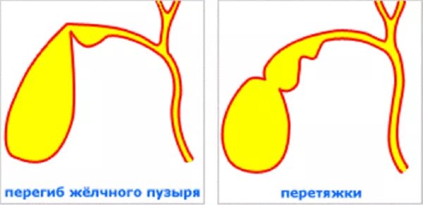 Перегиб нижней трети желчного пузыря. Перегиб желчного пузыря в области дна. Лабильный Перегиб в области тела желчного пузыря. Загиб шейки желчного пузыря. Желчный изгиб у ребенка