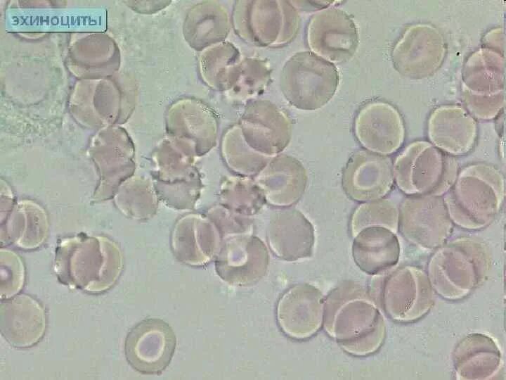 Эхиноциты эритроциты. Гемосканирование крови на паразитов. Паразиты в крови под микроскопом. Исследование крови под микроскопом паразиты. Эхиноциты