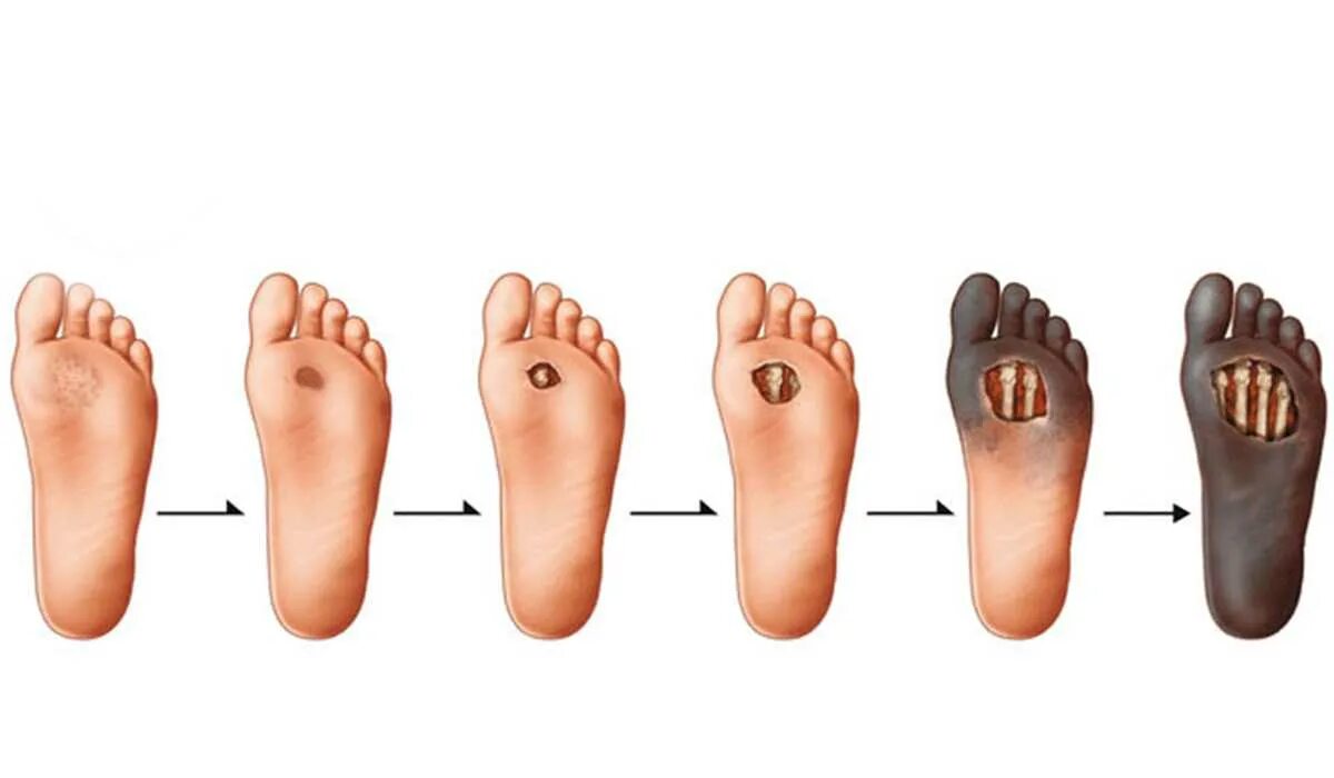 Синдром диабетической стопы некроз. Диабетическая стопа гангрена ног. Гангрена пальцев стопы диабетическая. Диабетическая стопа гангрена стопы. Пятка рот