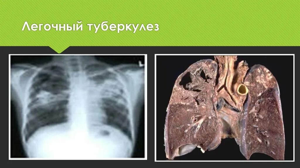 Удаление туберкулеза легких. Удаление туберкулеза легких. Диссеминированный кавернозный туберкулез. Операция при туберкулезе легких. Удаление туберкулеза легких.