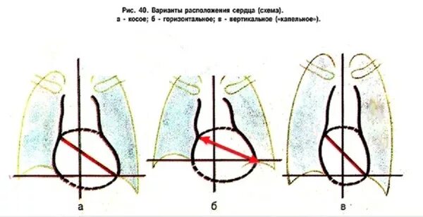 Горизонтальное положение сердца что это. Косое положение сердца. варианты расположения сердца. типы положения сердца. косое положение сердца на рентгенограмме.