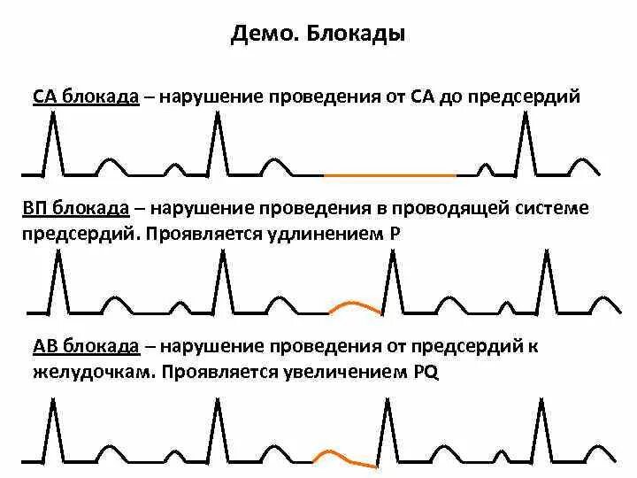 Са экг. Са экг