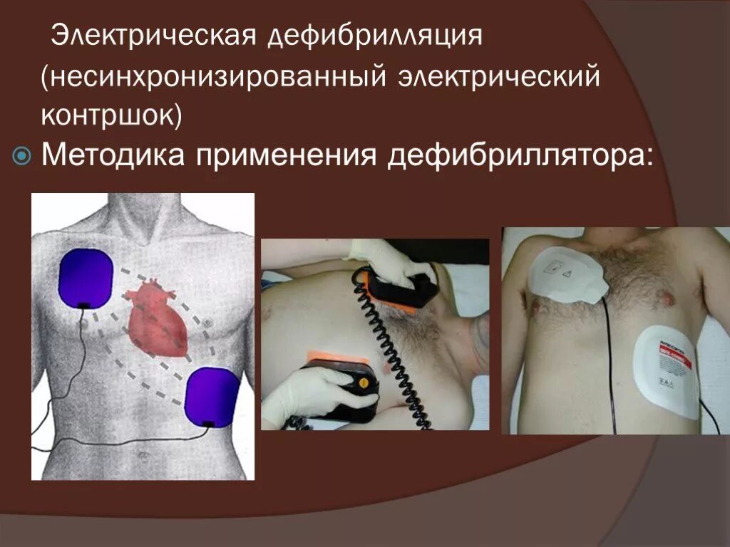 Выполнение дефибрилляции
