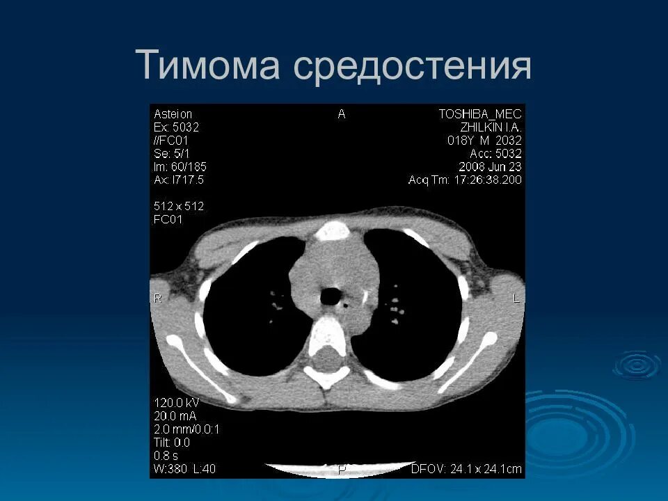 Тимус в переднем средостении