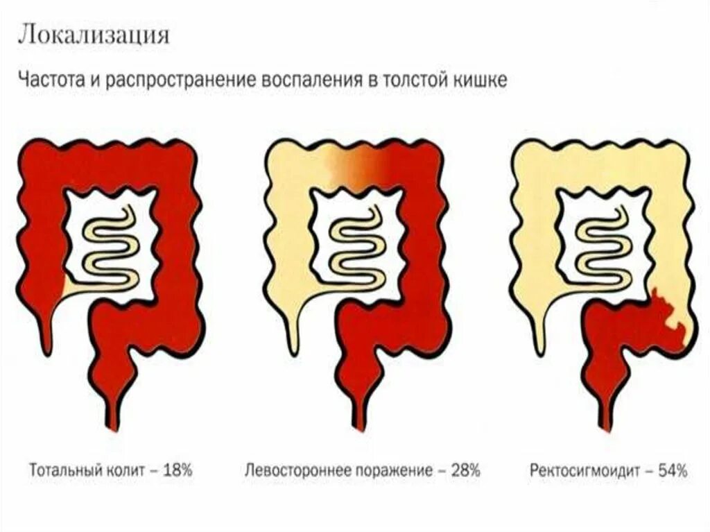 Сильные боли при колите