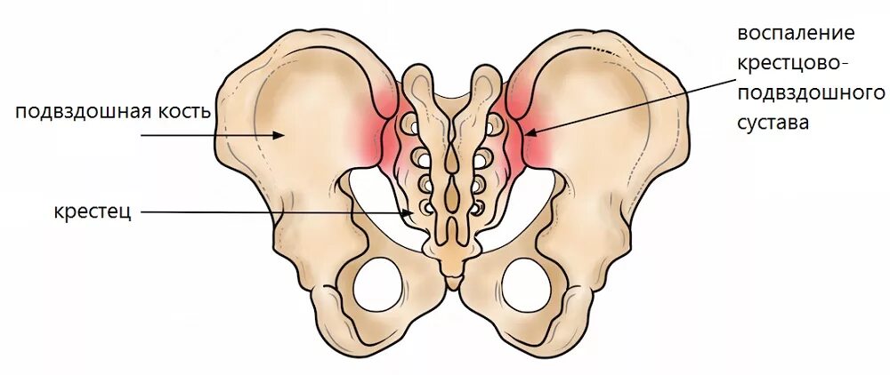 Сакроилеит крестцово-подвздошного сочленения. Крестцово подвздошное сочленение болезнь сакроилеит. Воспаление крестцово-подвздошного сустава. Кости крестцово подвздошного сустава.