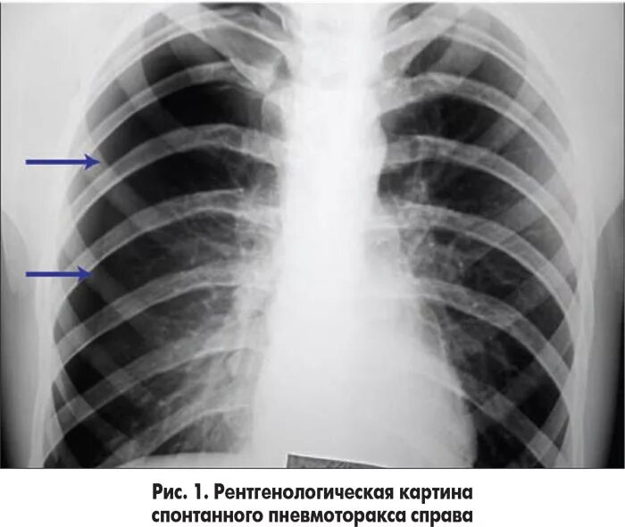 Коллабированное легкое при пневмотораксе