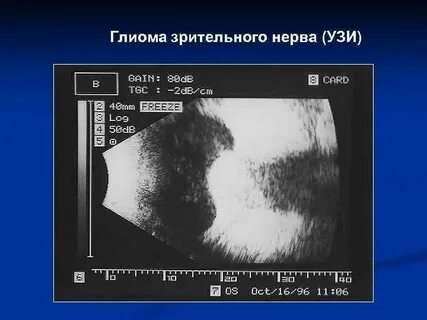 Узи зрительного нерва