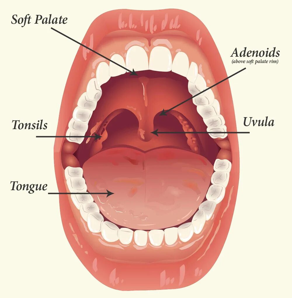 Язычок во рту как называется. Миндалины, аденоиды у ребенка, детей. Аденоиды это разрастание лимфоидной ткани. Как расположены аденоиды у ребенка. Гланды аденоиды миндалины что это.