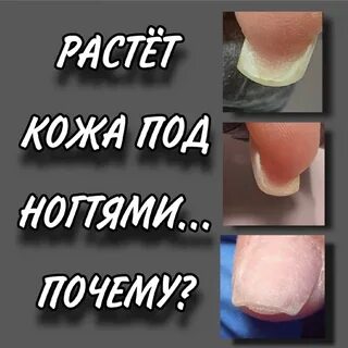 Гипонихий это