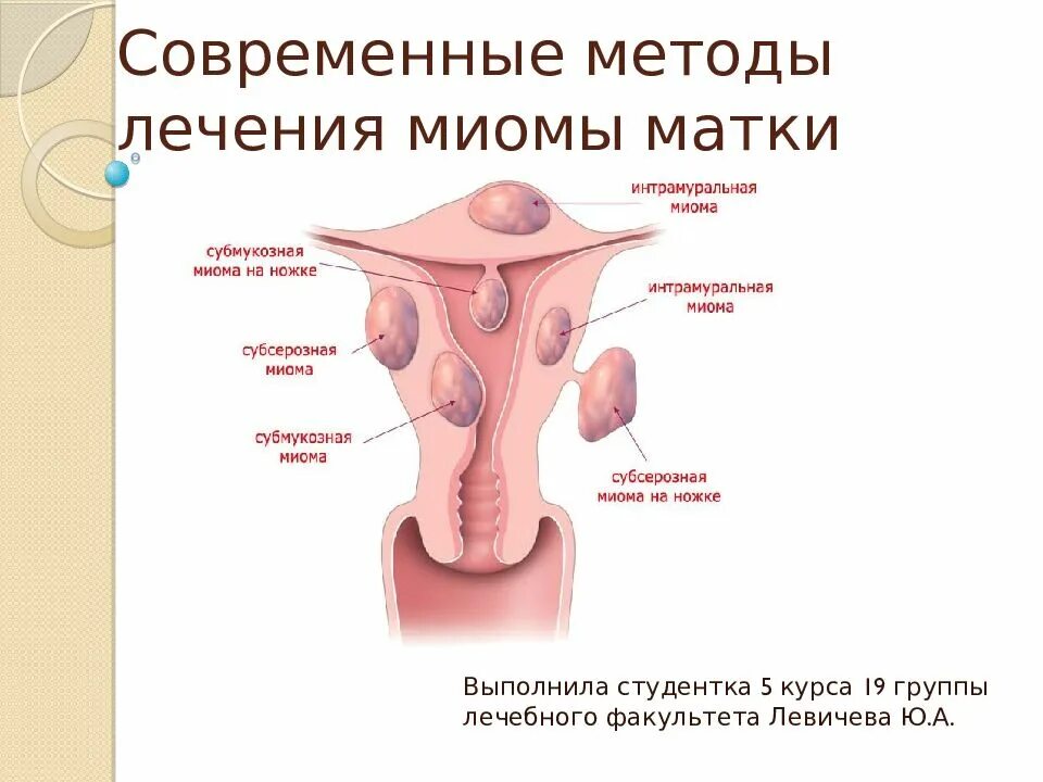 Лейомиома матки что это. Презентация на тему миома матки. Современные методы лечения миомы матки.