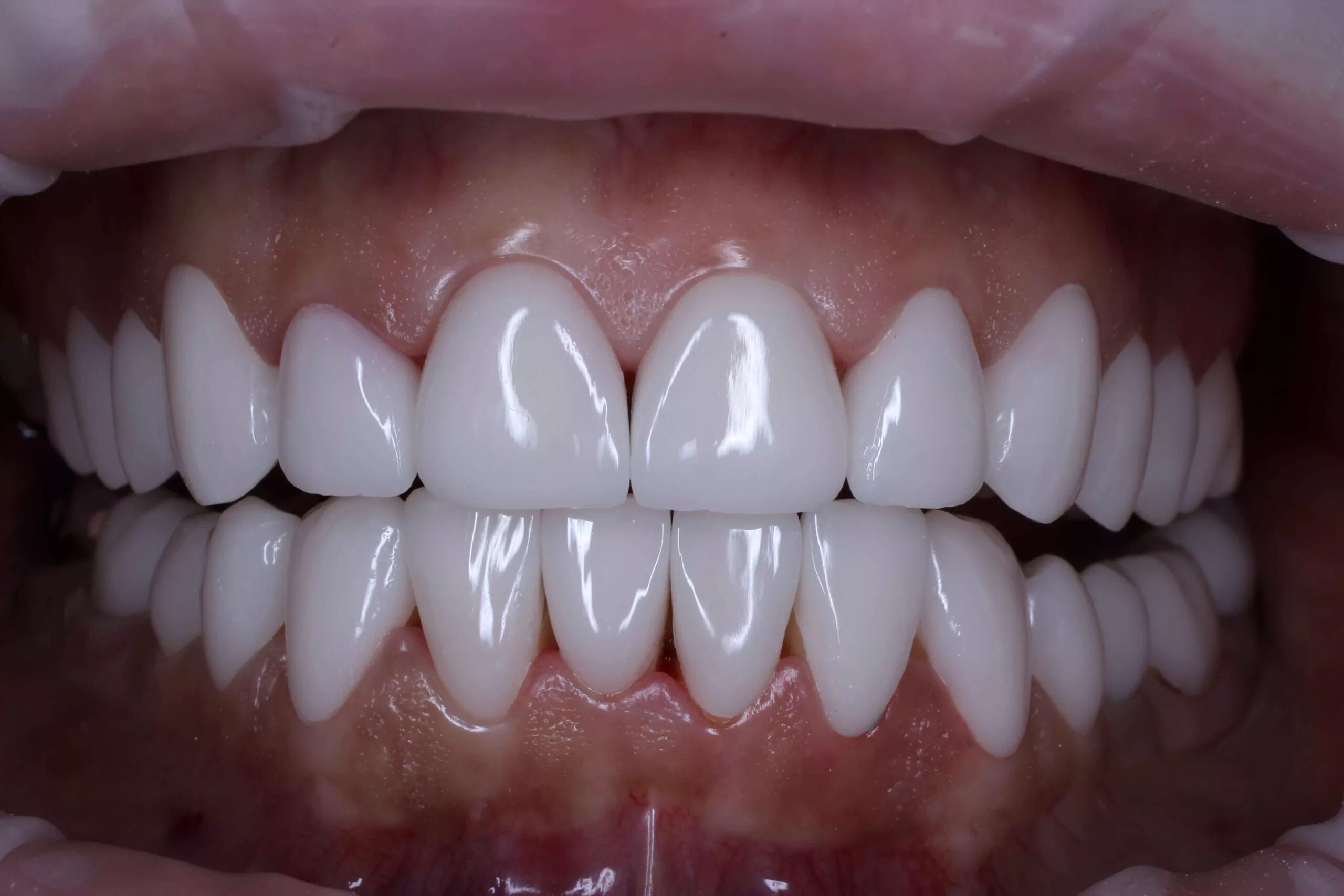 цельнокерамическая коронка press-керамика emax. е макс безметалловая керамика. керамические виниры блич 2. безметалловая керамика emax. виниры цельнокерамические emax.