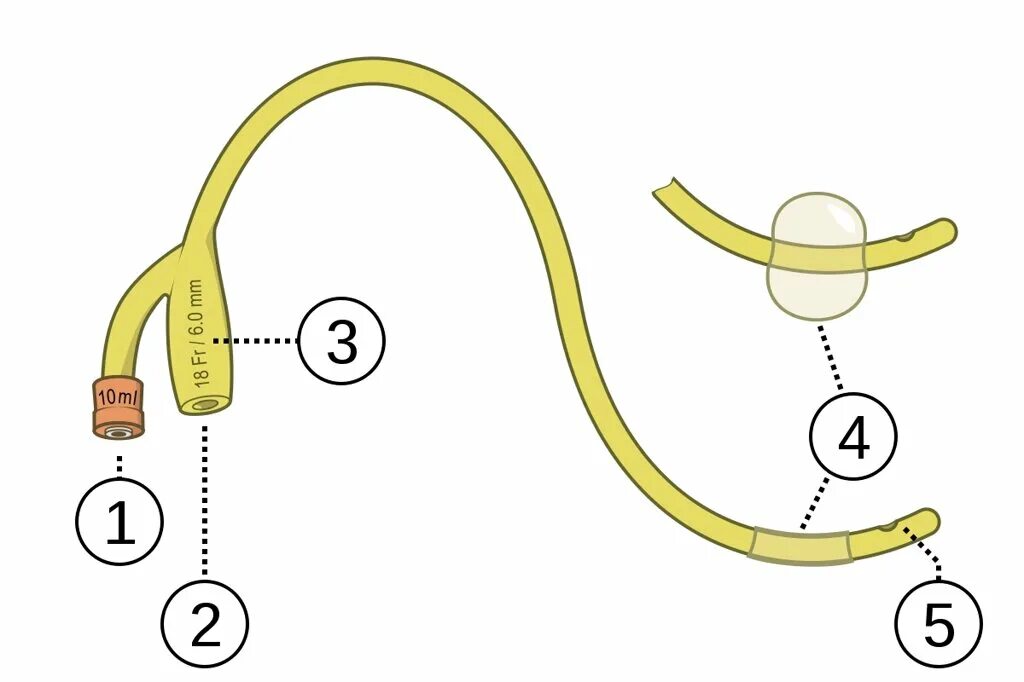 катетер фолея трехходовой. трехпросветный центральный венозный катетер. проксимальный конец катетера это. катетер легочной артерии. проксимальный конец катетера это.