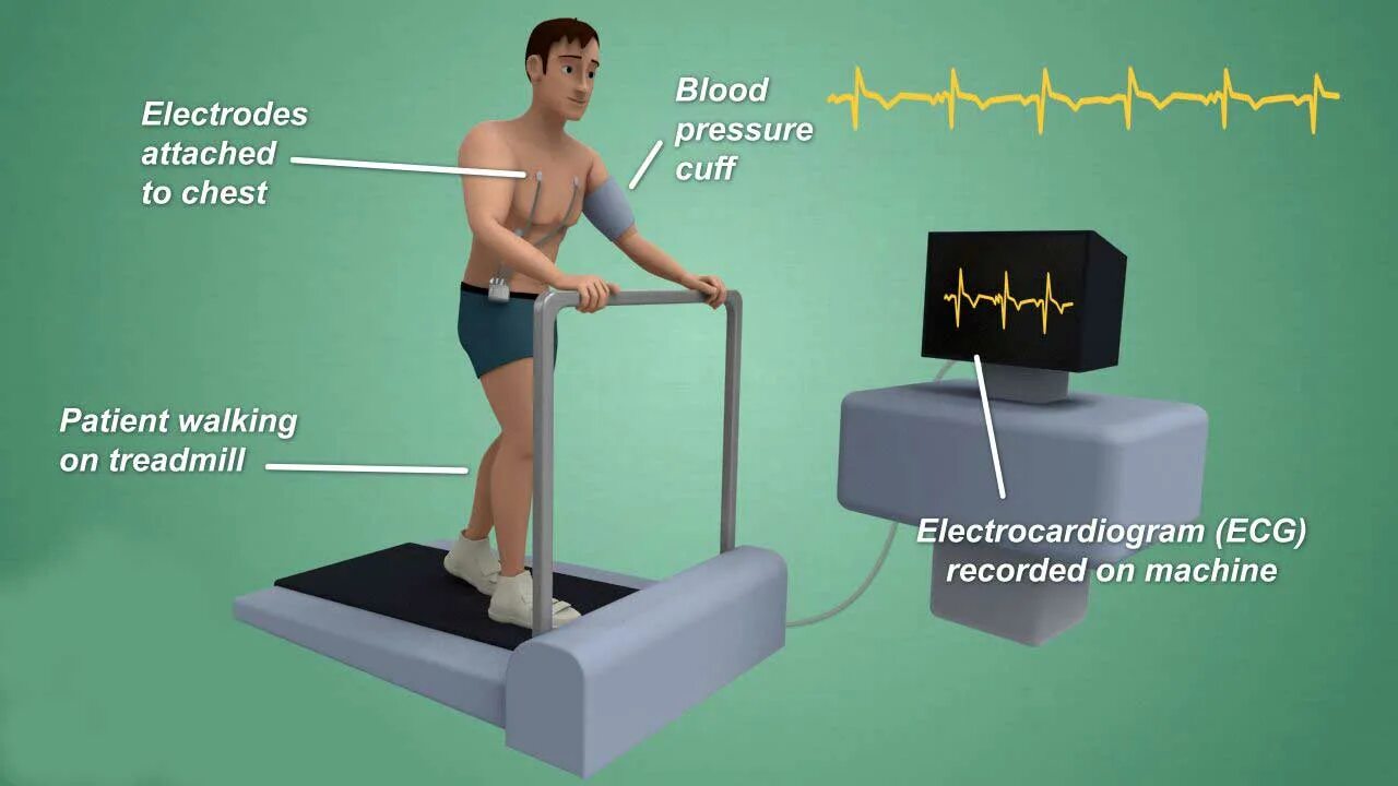Стресс пробы. Методы тестирования - велоэргометрия, тредмил.. Стресс ЭКГ. Стресс ЭКГ исследование что это такое. Стресс ЭКГ С нагрузкой.