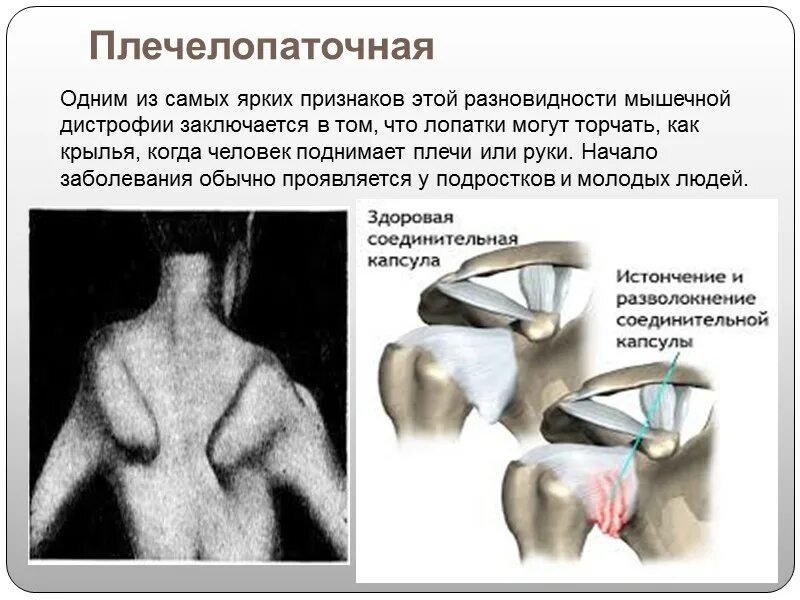 Миопатия ландузи. Плече лопаточно лицевая форма Ландузи Дежерина. Мышечная дистрофия Дежерина. Плече-лопаточно-лицевая мышечная дистрофия. Лице лопаточно плечевая мышечная дистрофия.